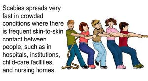 scabies